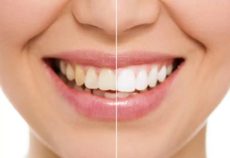 teeth whitening